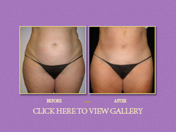 Abdominoplasty (Tummy Tuck)