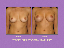 Breast Augmentation (Enlargement) - Saline Implants