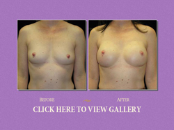 Breast Reconstruction