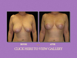 Breast Reduction