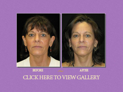 Facelift