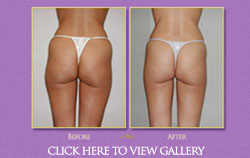 Liposuction