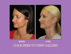 Rhinoplasty